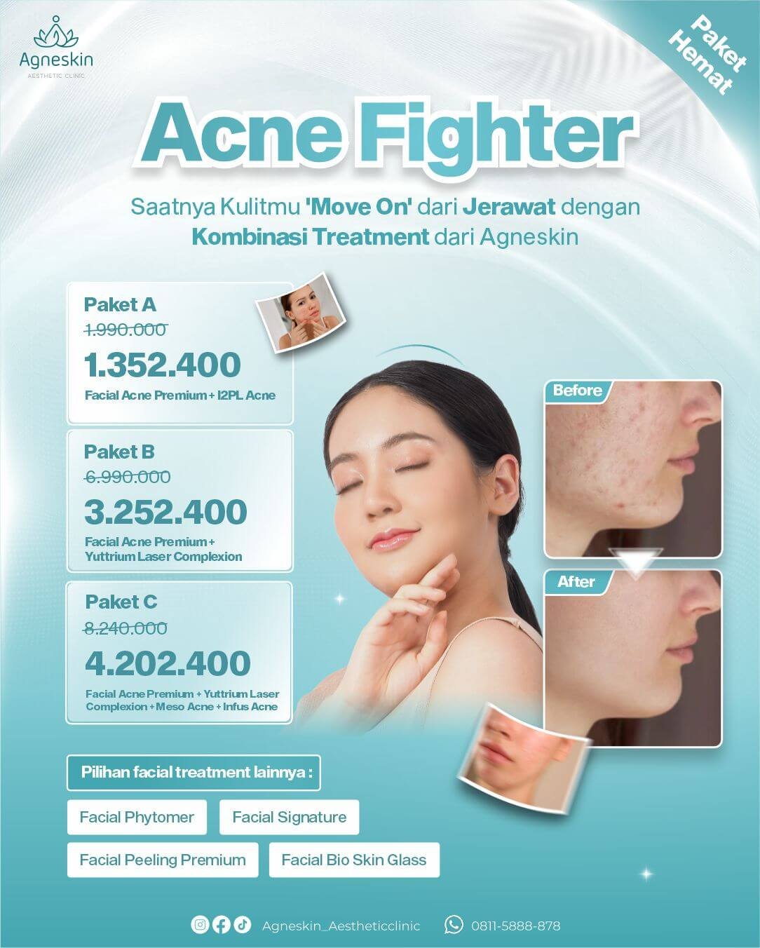 Acne Fighter