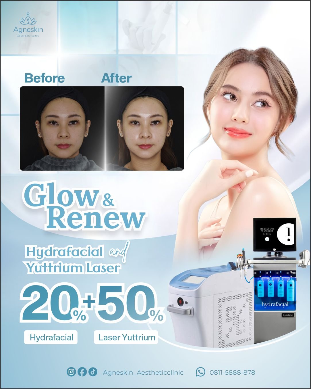 hydrafacial laser