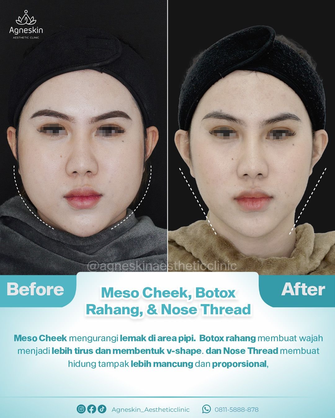 meso cheek, botox rahang, nose thread