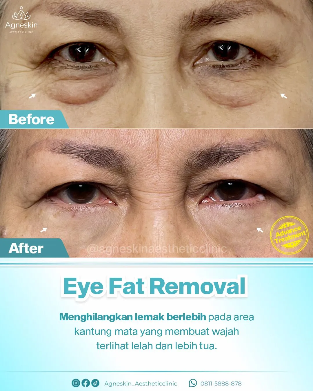 Eye Fat Removal