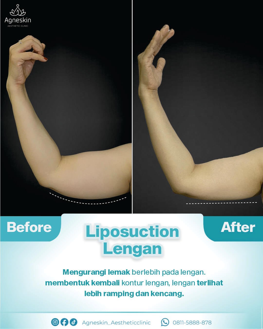 Liposuction-Lengan-Feb-2023.jpg