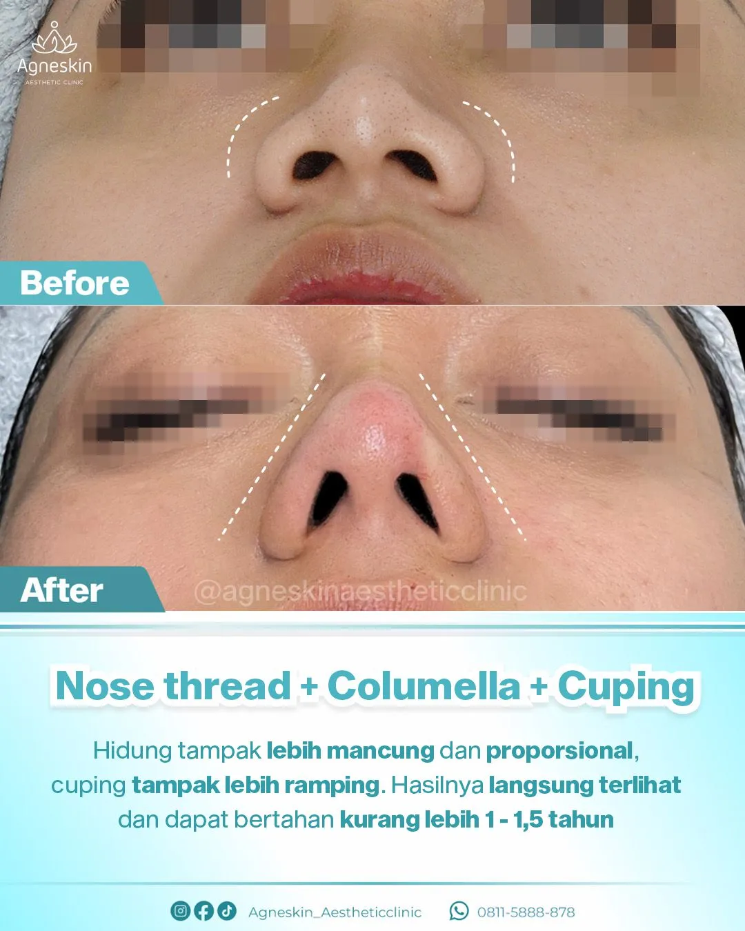 Nose Thread Widyawati