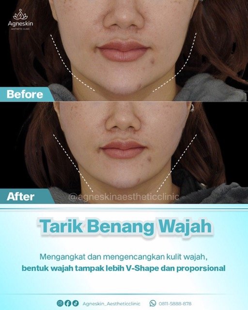 Tarik benang wajah 2a Medium