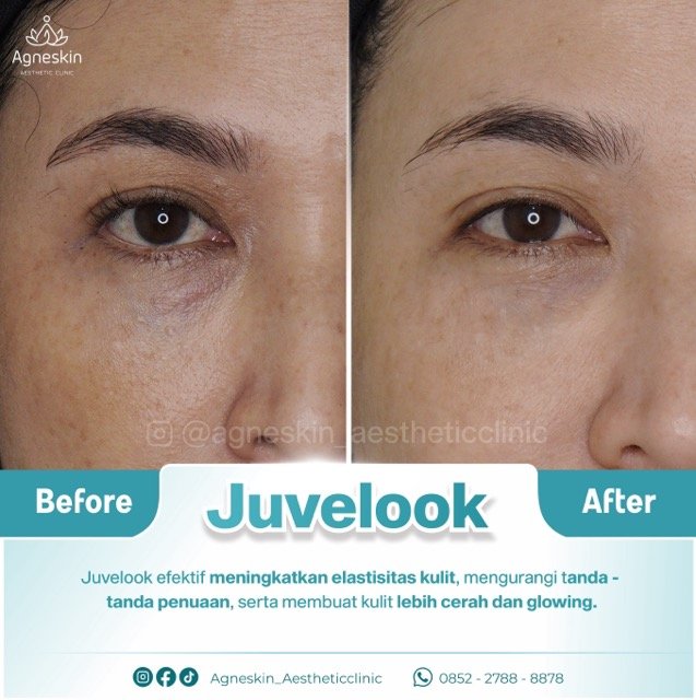 juvelook 1 Medium