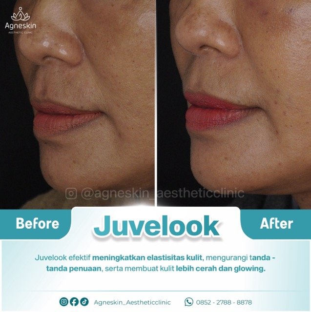 juvelook mba ning Medium