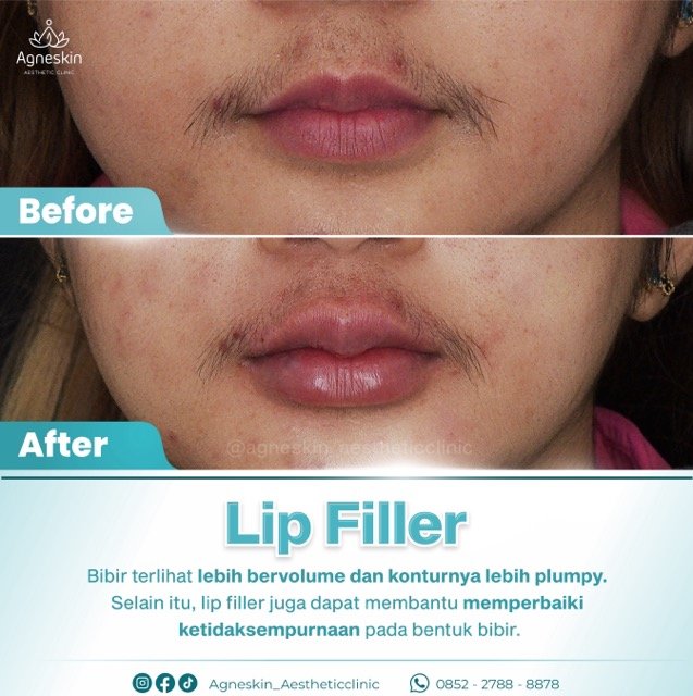 lip filler 1 Medium