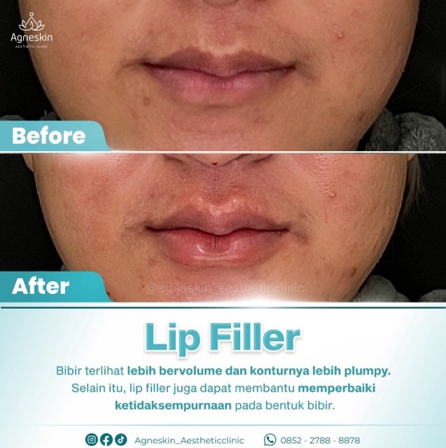 lip filler 2 Medium