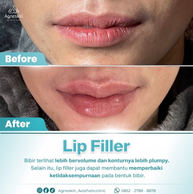 lip filler 3 Medium