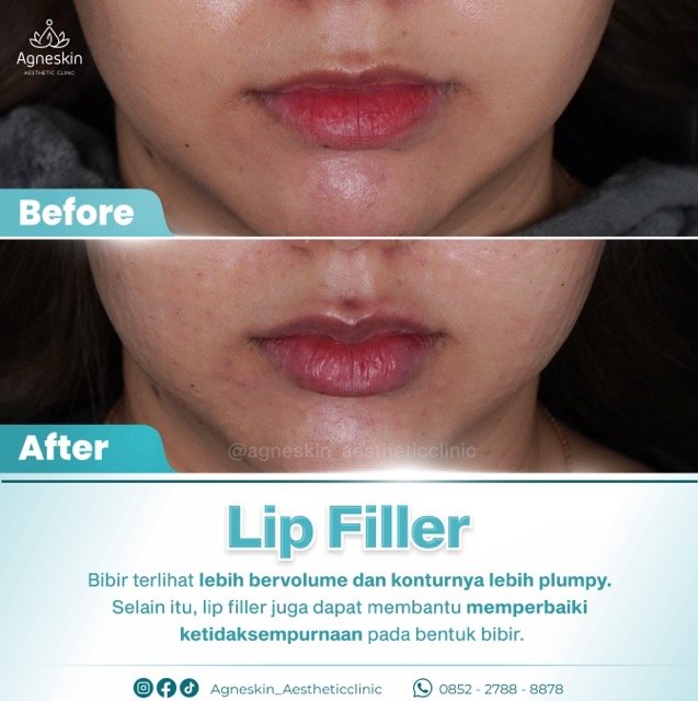 lip filler 4 Medium