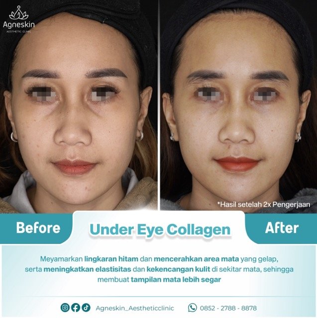 under eye collagen Medium