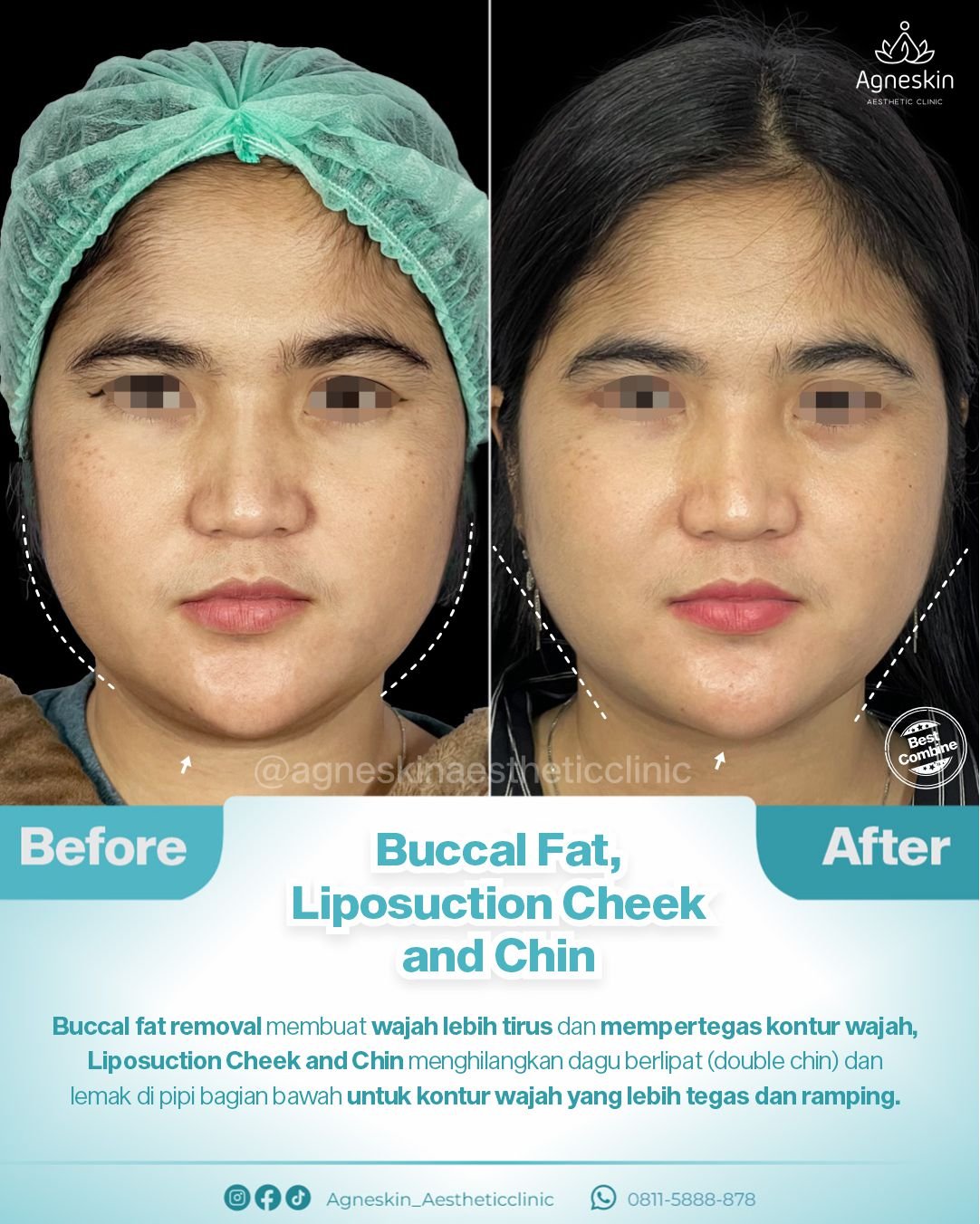 Buccal Fat lipo cheek dan chin