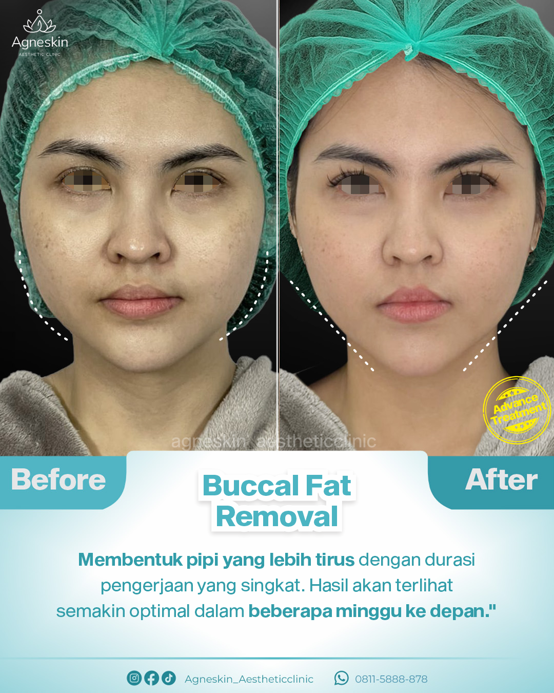 Buccal fat removal