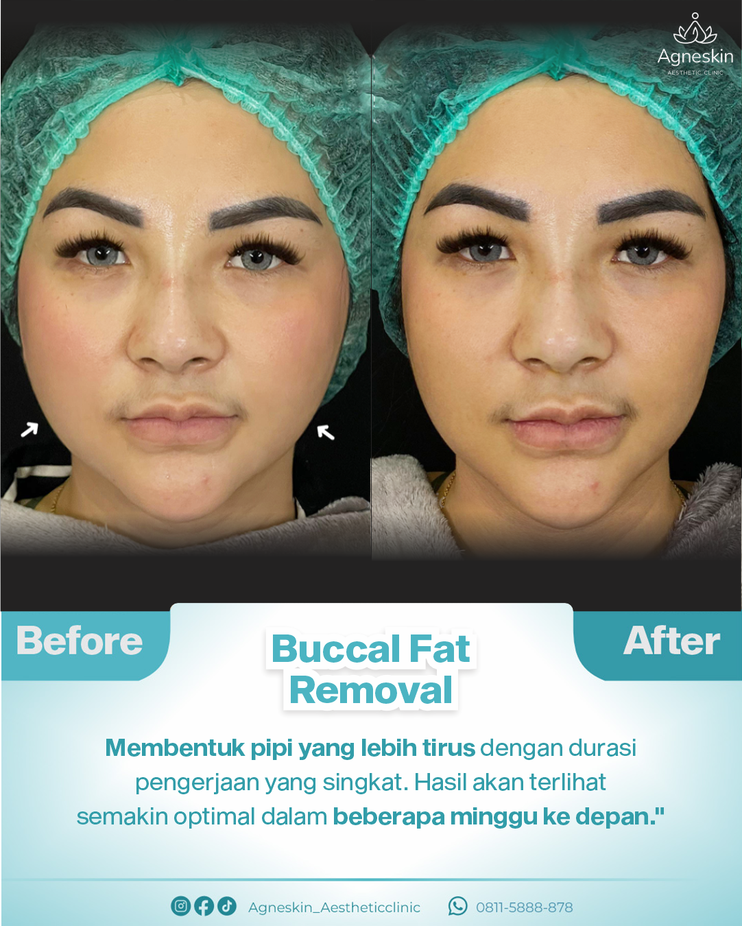 Buccal fat removal adiez momo