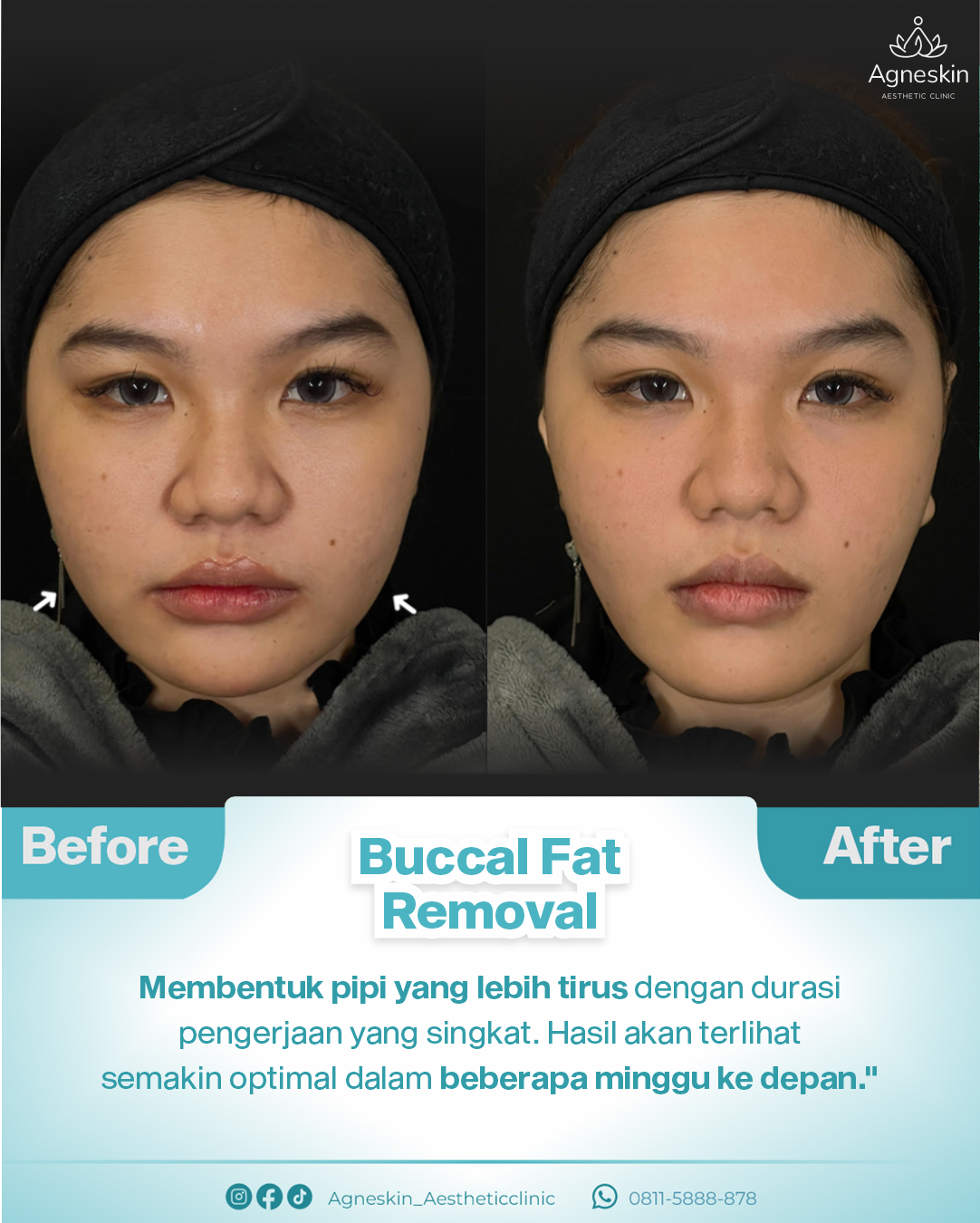 Buccal fat removal mila