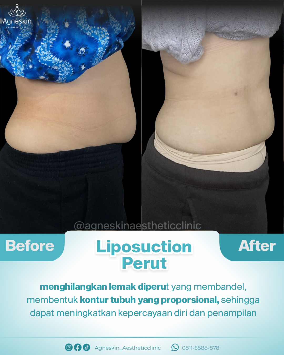 Liposuction perut