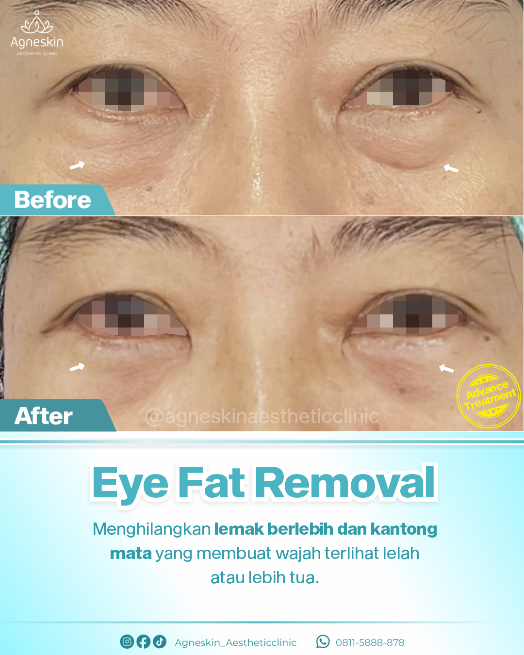 eye fat removal 1