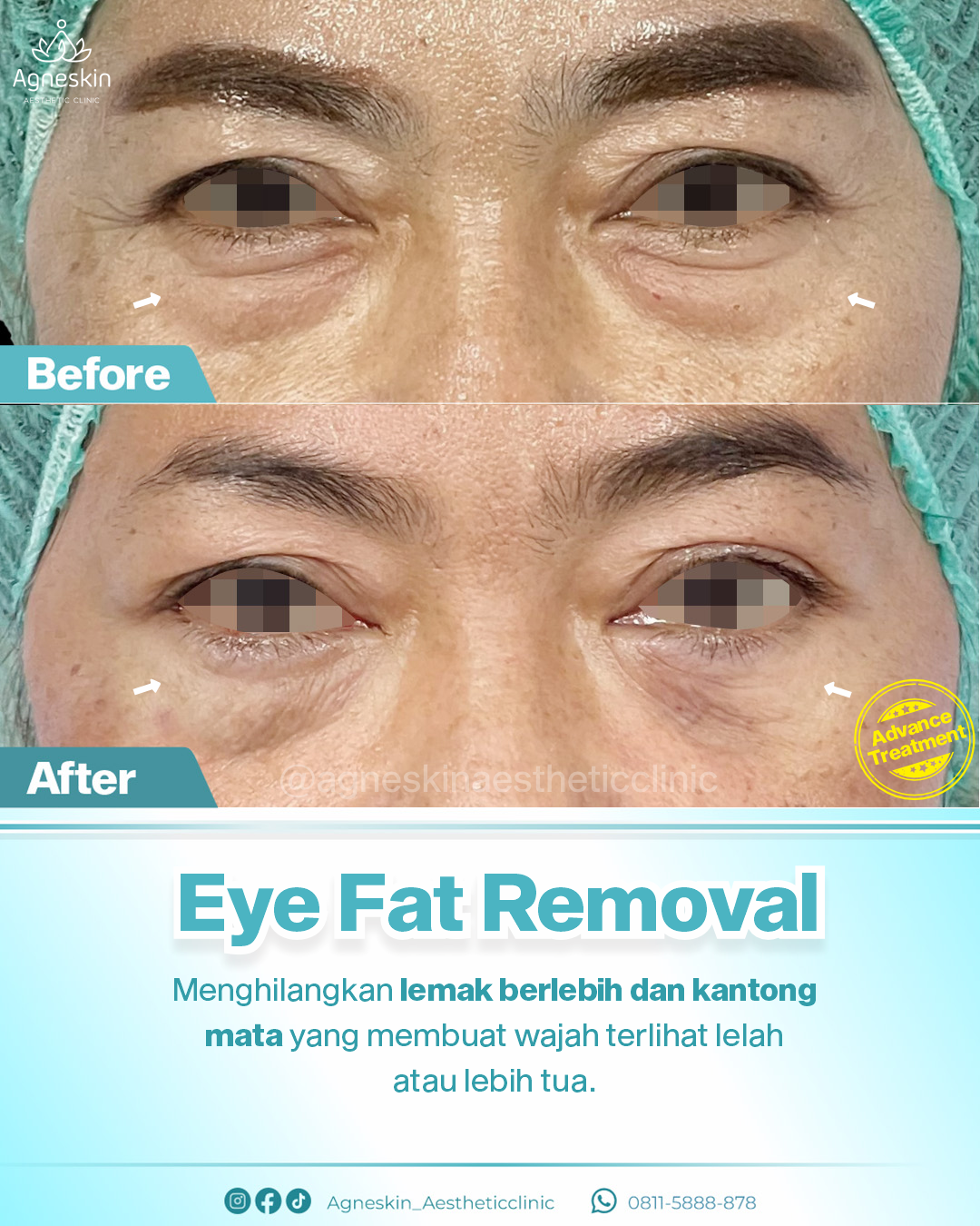 eye fat removal 2