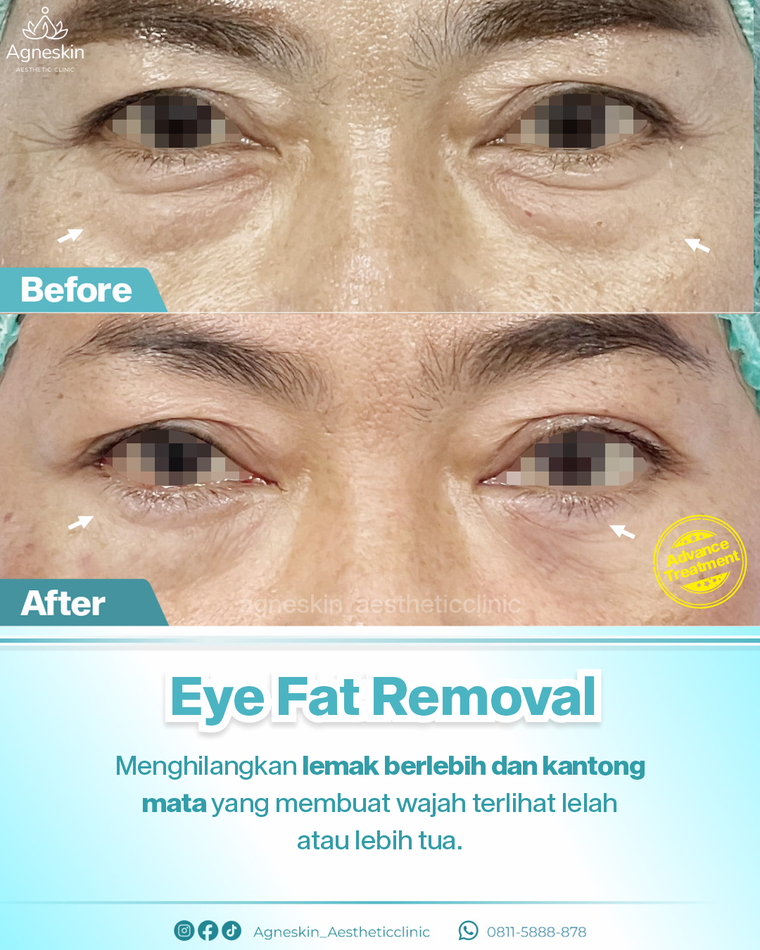 eye fat removal