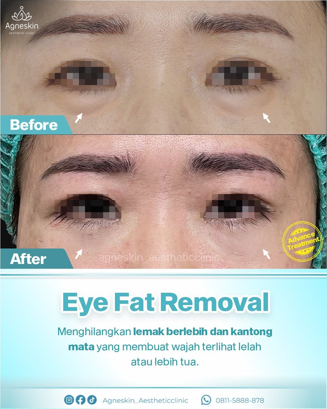 eye fat removal2 stamp