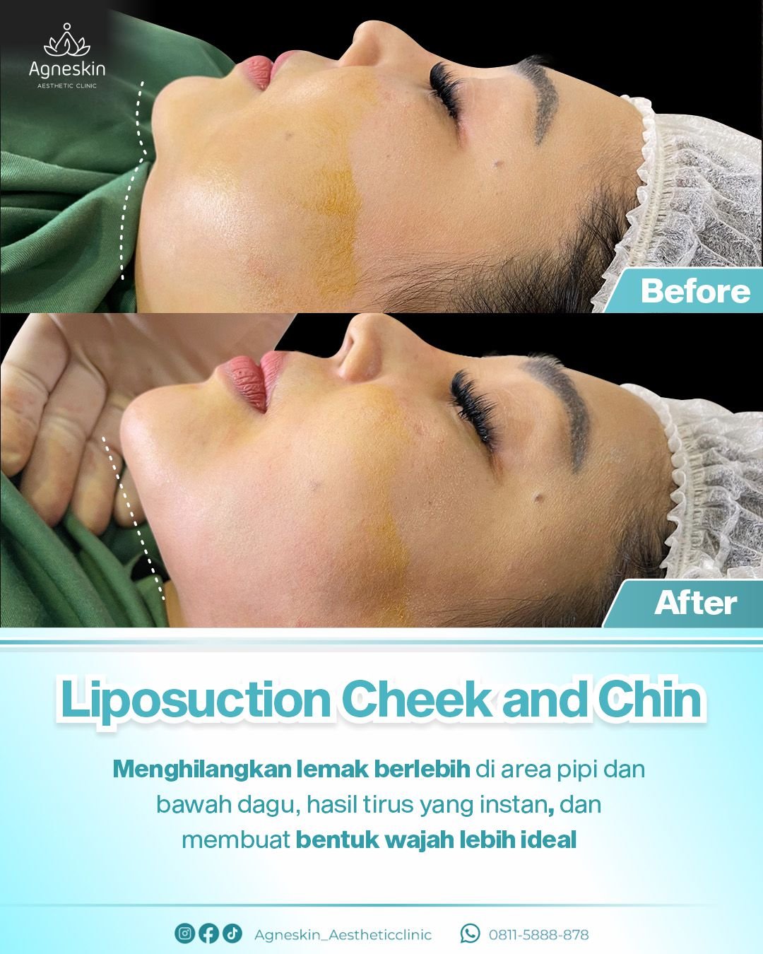 liposuction cheek and chin