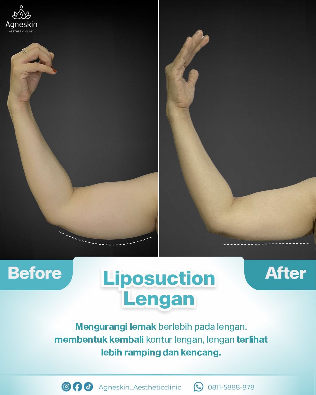 liposuction lengan